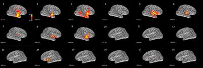 Lateralization Value of Low Frequency Band Beamformer Magnetoencephalography Source Imaging in Temporal Lobe Epilepsy